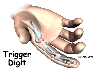 Trigger Finger and Trigger Thumb